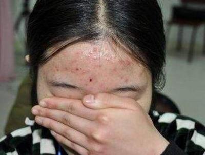 脸蛋反复起痘痘是什么原因