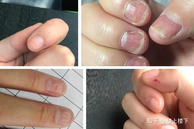 去指甲上死皮有什么用